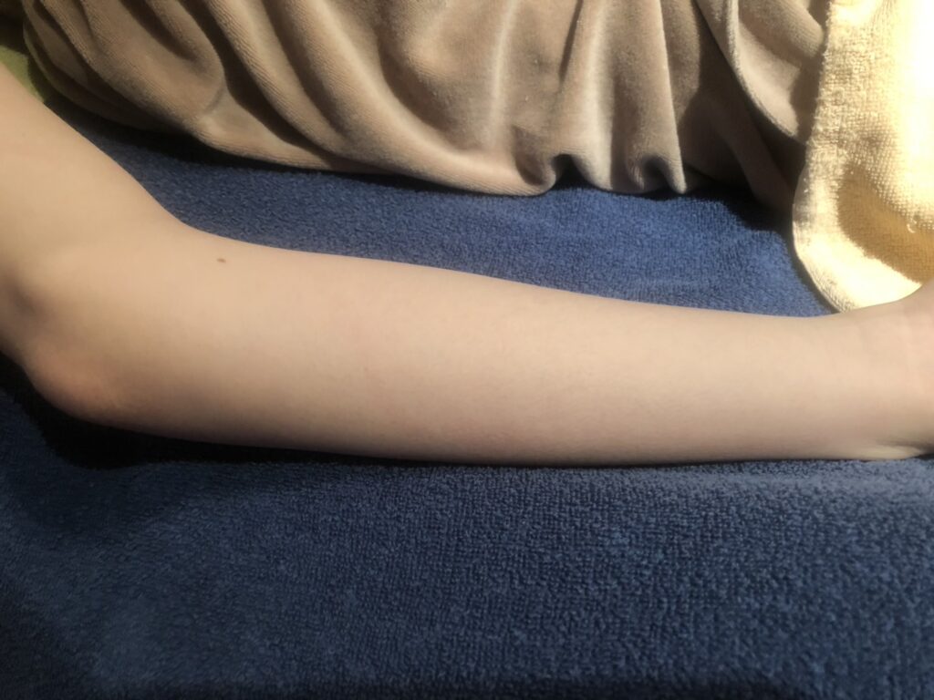 腕脱毛After
