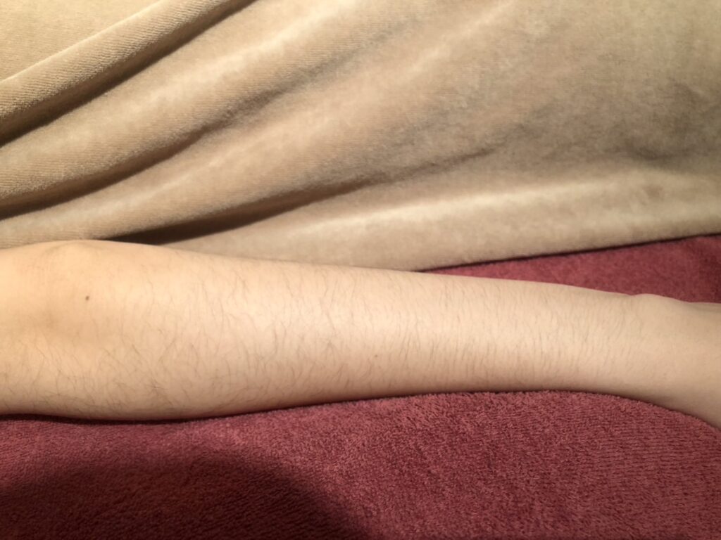 腕脱毛Before