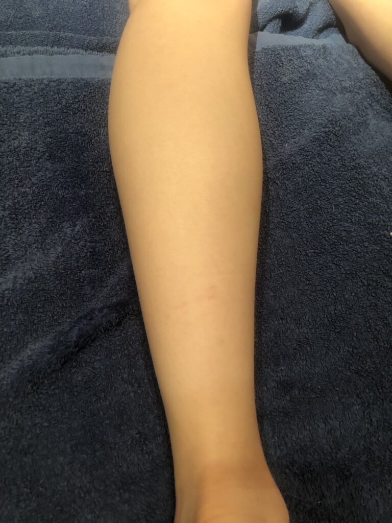 足脱毛After