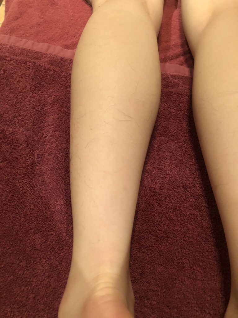 足脱毛Before