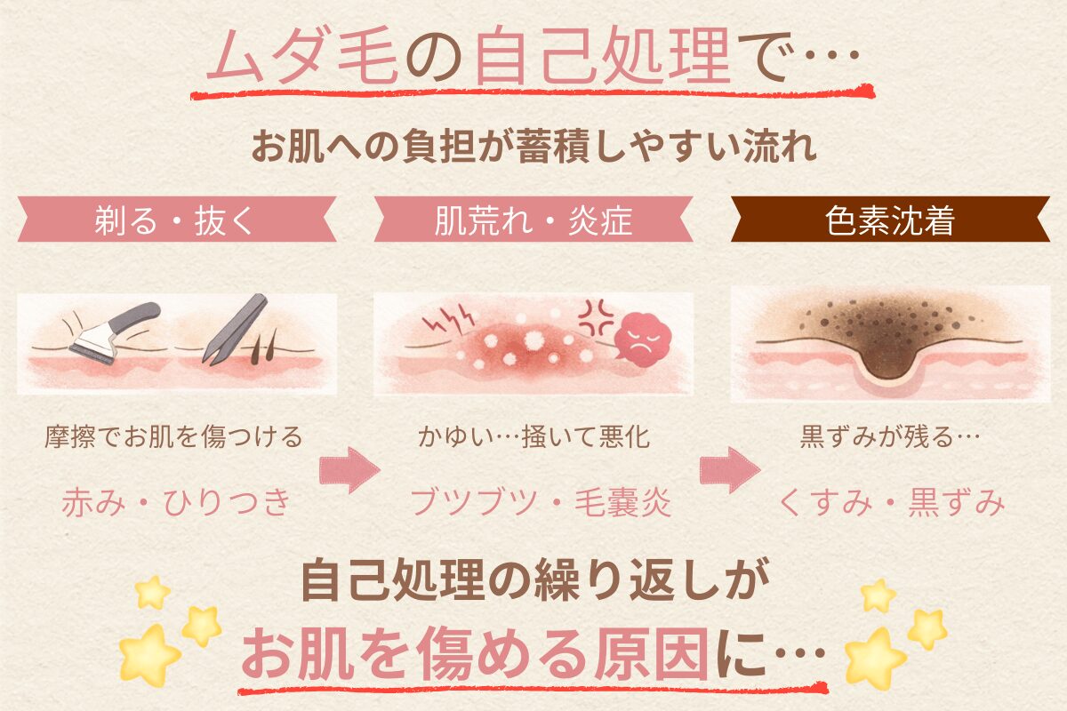 女子高校生のムダ毛の自己処理で起きやすい肌トラブルの流れ(摩擦→赤み・ひりつき→肌荒れ・毛嚢炎→色素沈着)